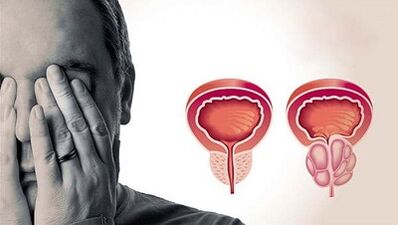 Motivele dezvoltării prostatitei la bărbați